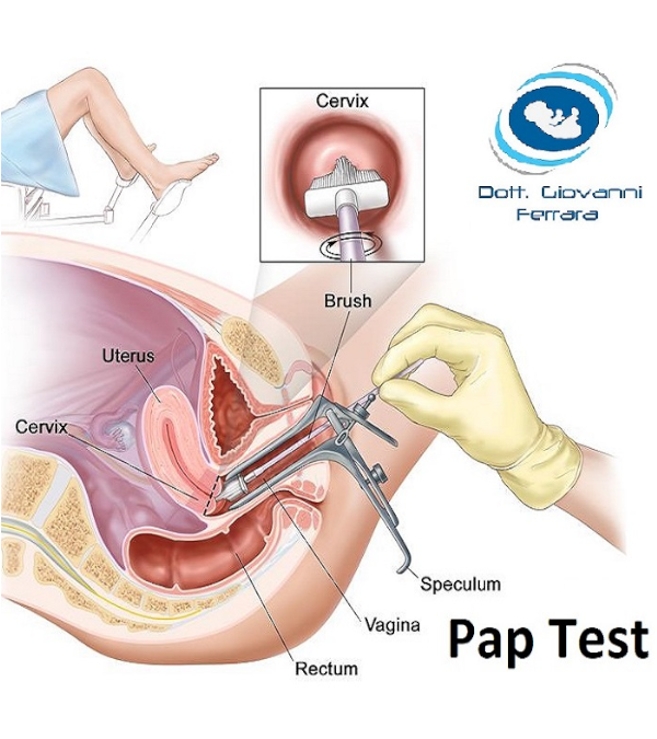 Visita ginecologica con Pap test e Brush endocervicale