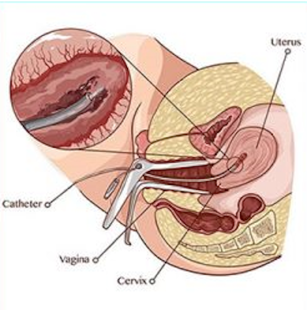 Visita ginecologica con Pap test e Brush endocervicale